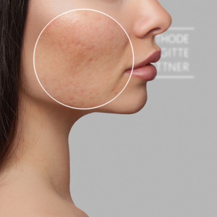What Causes Hyperpigmentation?