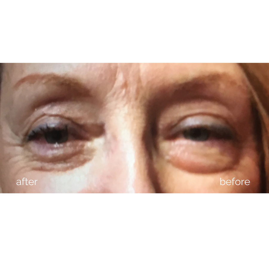 MBK Eye Rejuvenator - Your Ultimate Solution for Ageless Eyes!